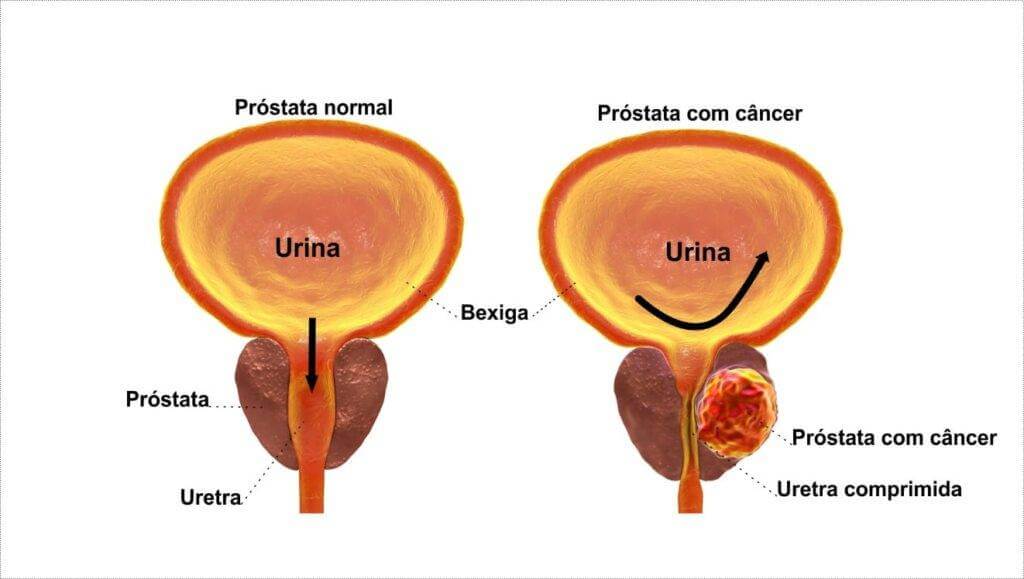 Cancer de prostata