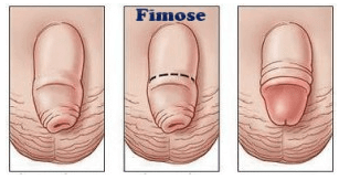 Fimose
Excesso de Prepúcio