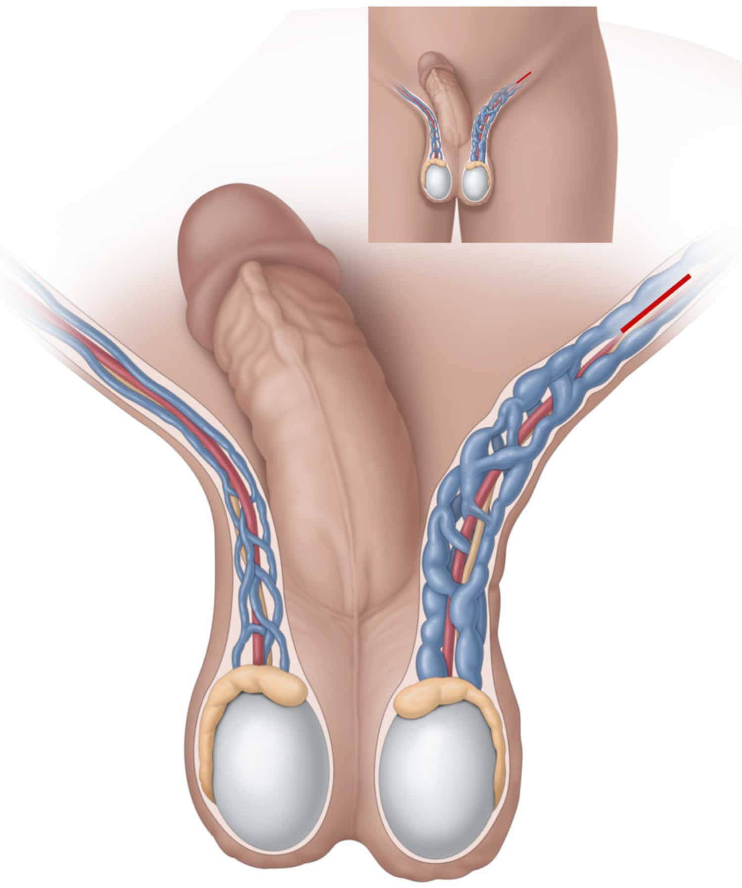 VARICOCELE