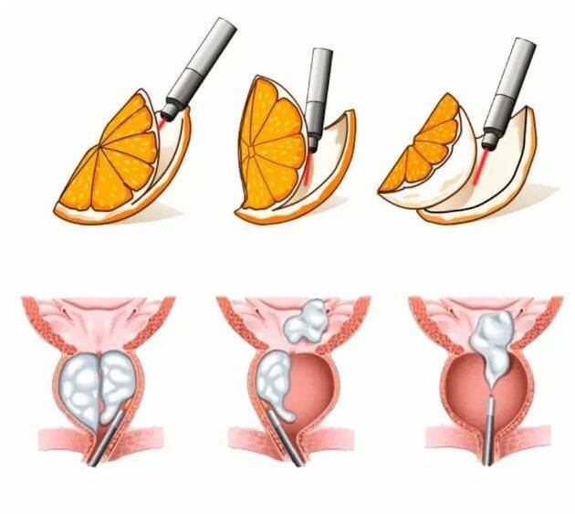 Cirurgia Holep Próstata
