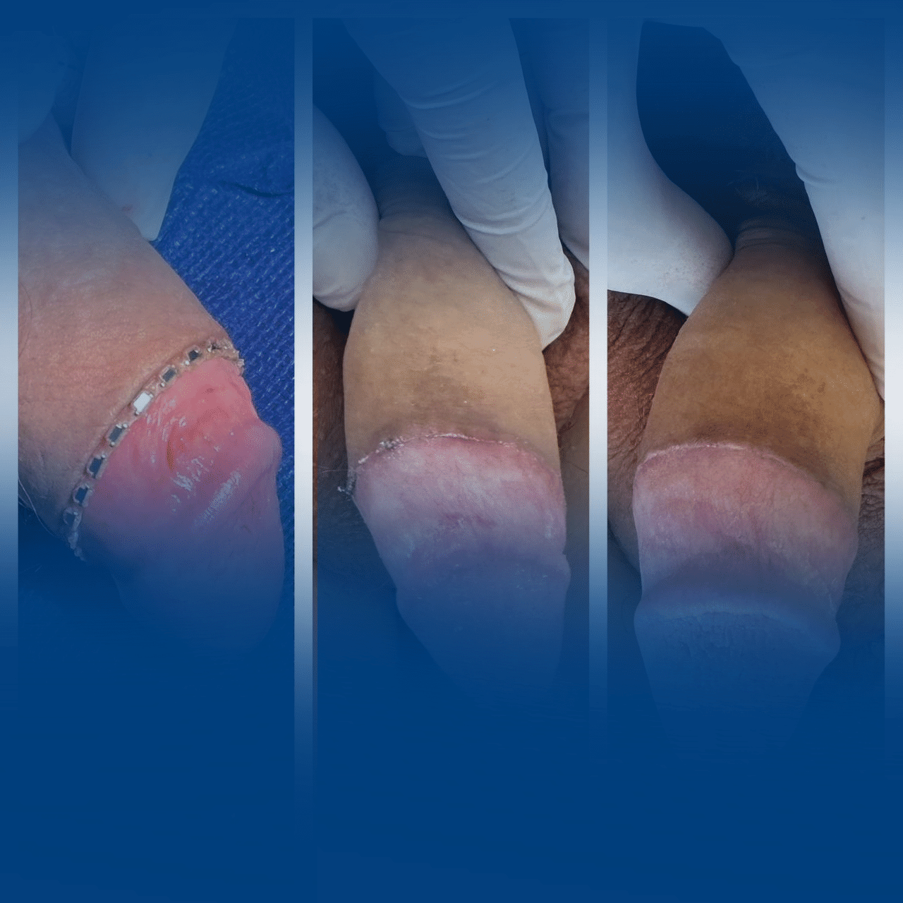 cirurgia de fimose com grampeador